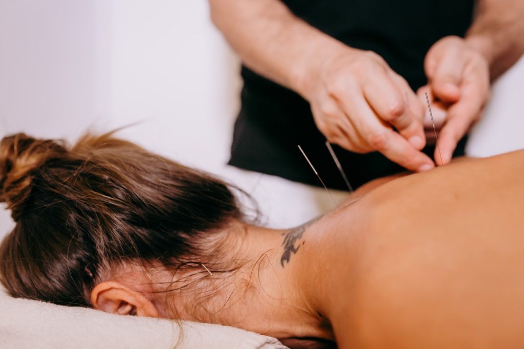 woman receiving acupuncture to back and neck